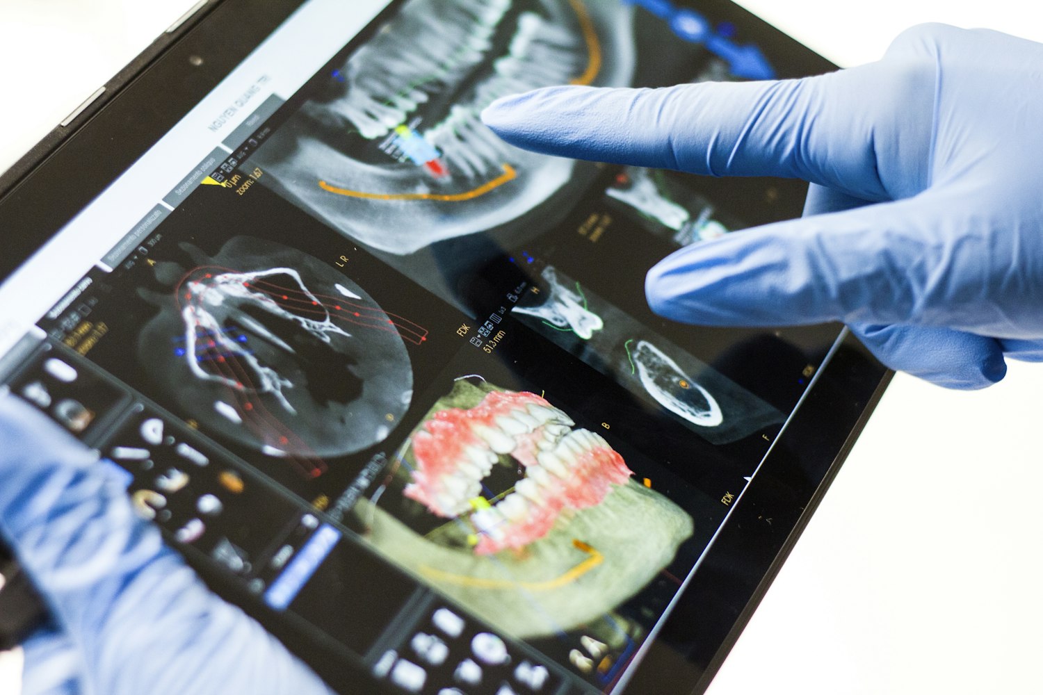3-on-6 Dental Implants Cost UK: The Honest Breakdown