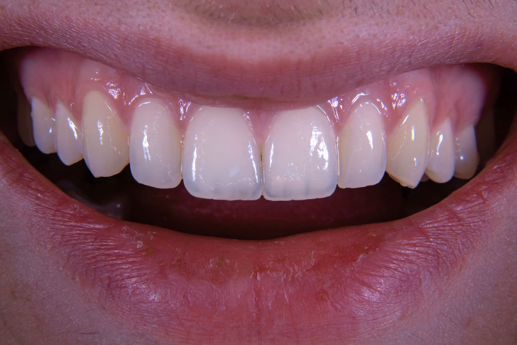 All-on-4 Dental Implants Cost UK: Complete Price Breakdown for 2026