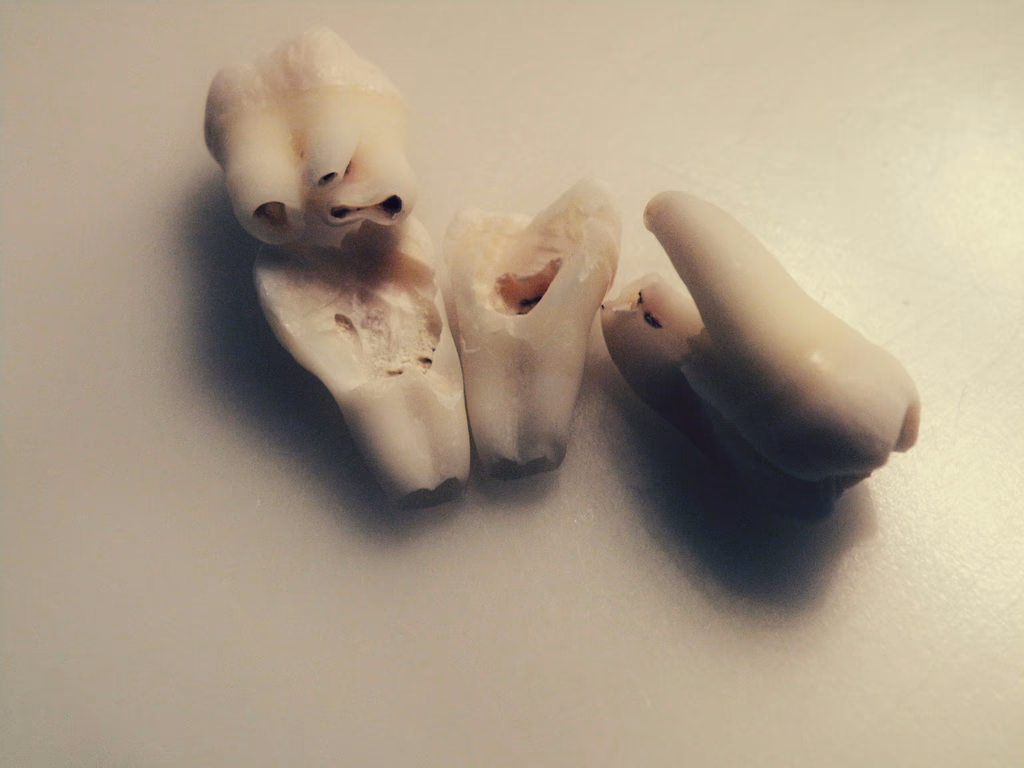 Broken Tooth Emergency Repair Cost: From £100 Chips to £2,500 Disasters