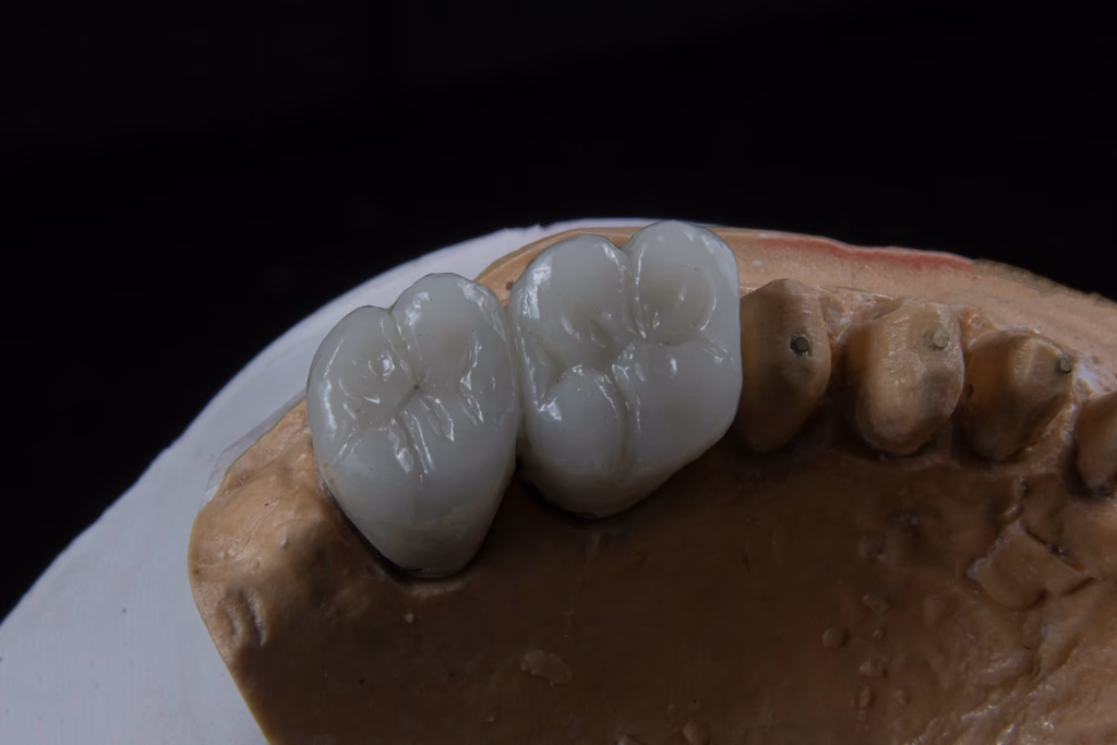 Dental Implant vs Bridge Cost Comparison: The Real 10-Year Math