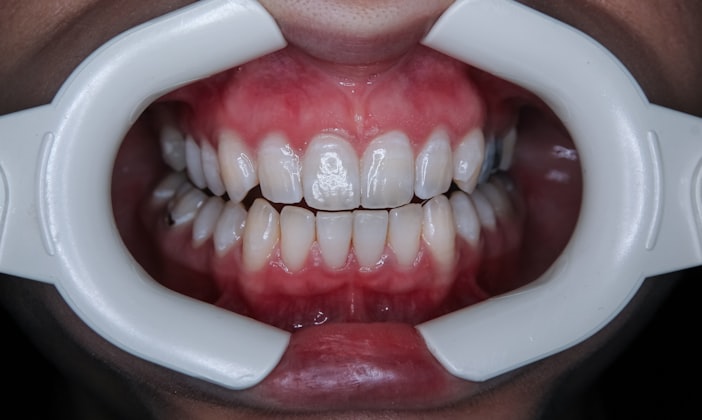 Do Wisdom Teeth Need Removing? (When to Act and When to Leave Them Alone)