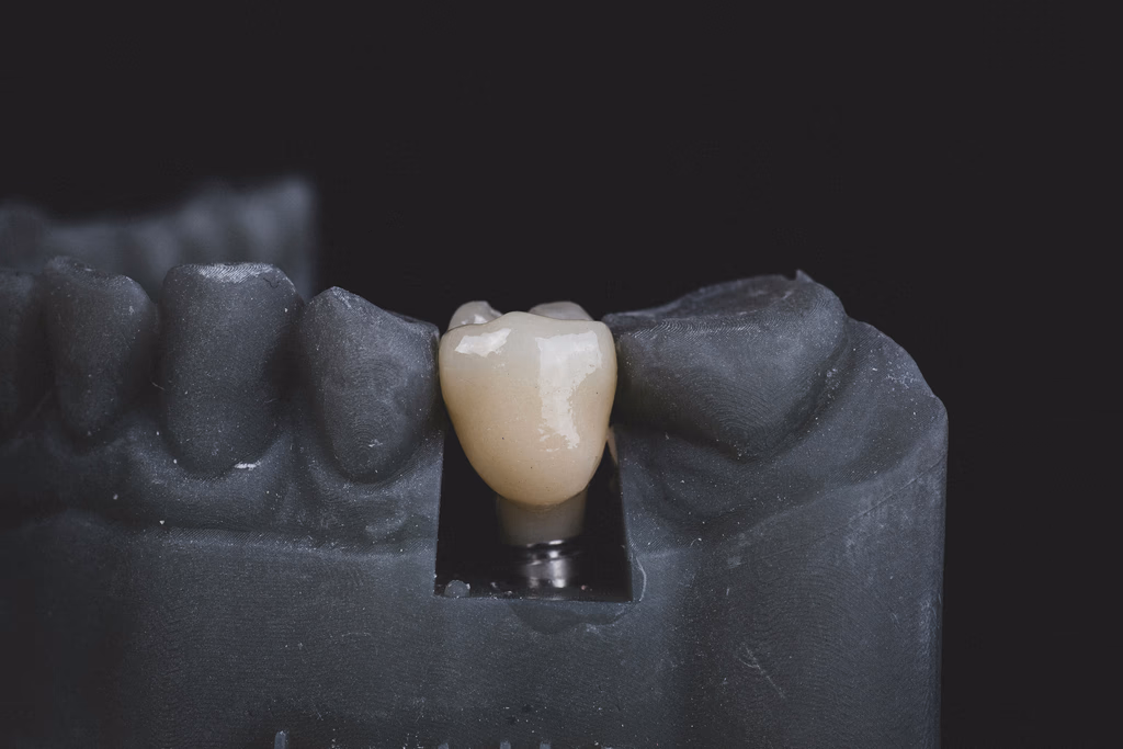 How Long Do Dental Implants Last