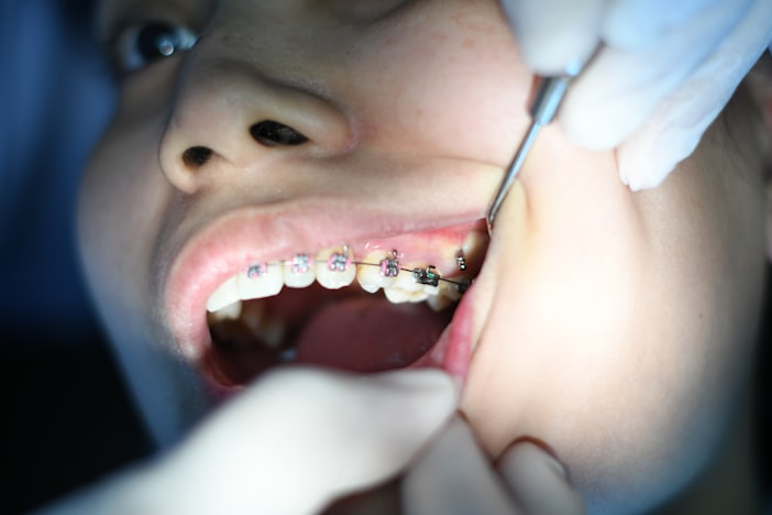 How Long Do Fillings Last? Lifespan by Type, and When They Need Replacing