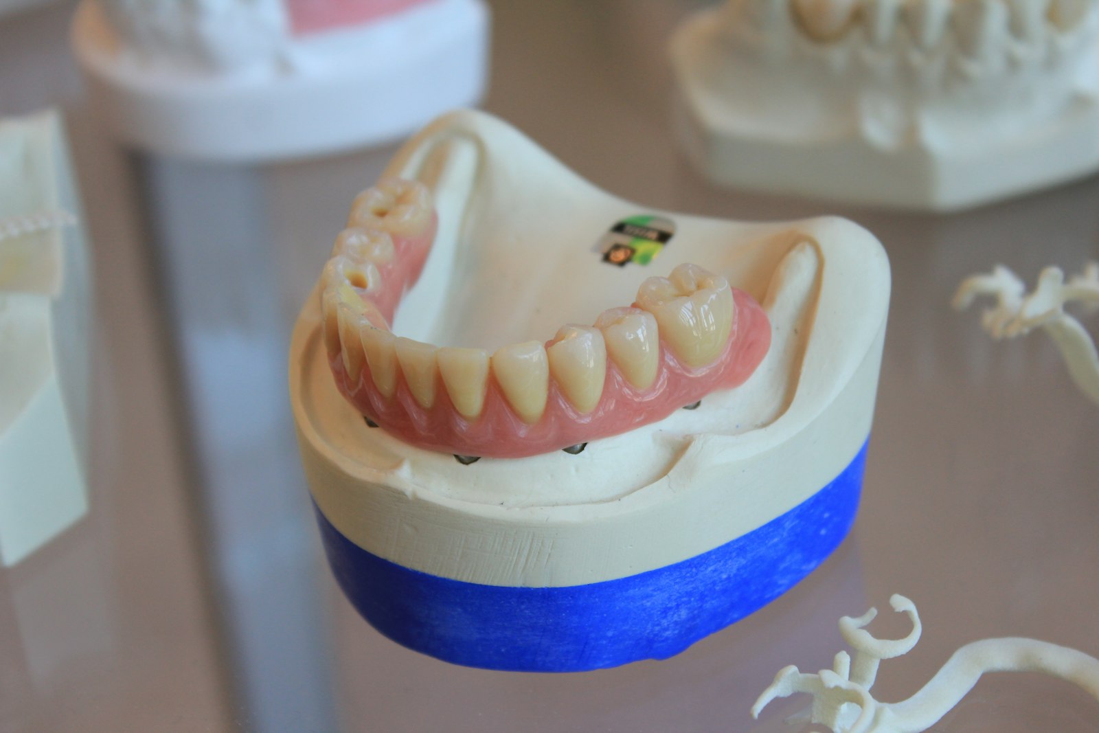How Long Does It Take to Get Dentures? The Real Timeline