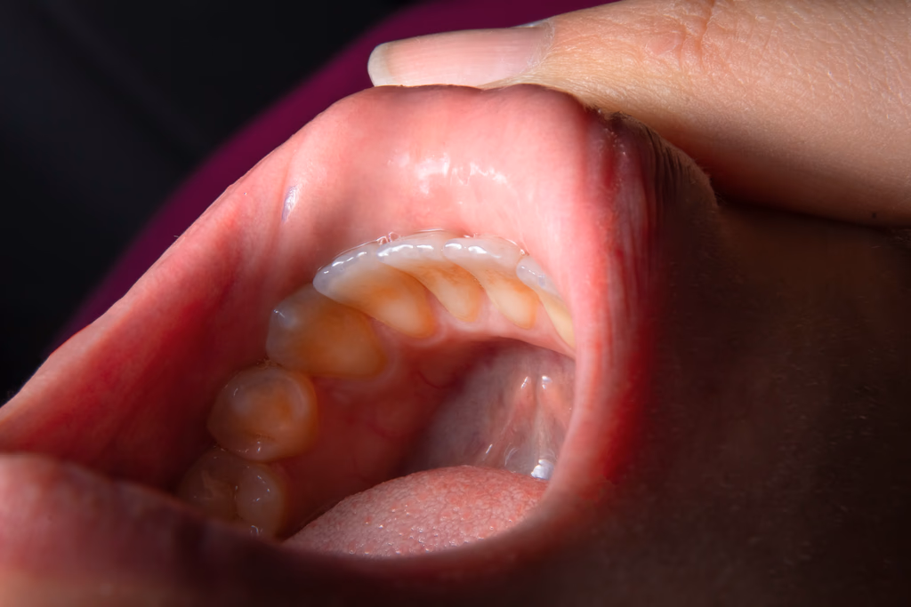Sensitive Teeth Treatments