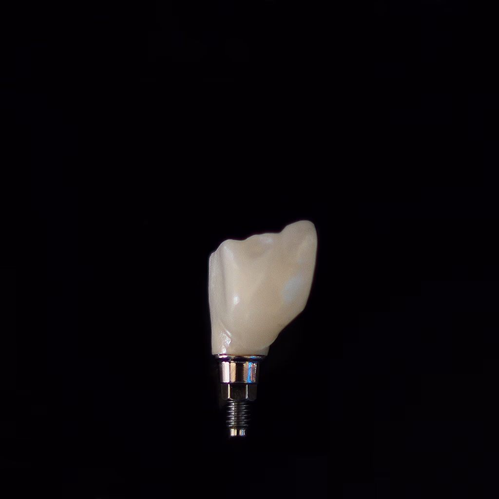 Single Tooth Implant Cost 2026: £1,500-£3,500 Explained
