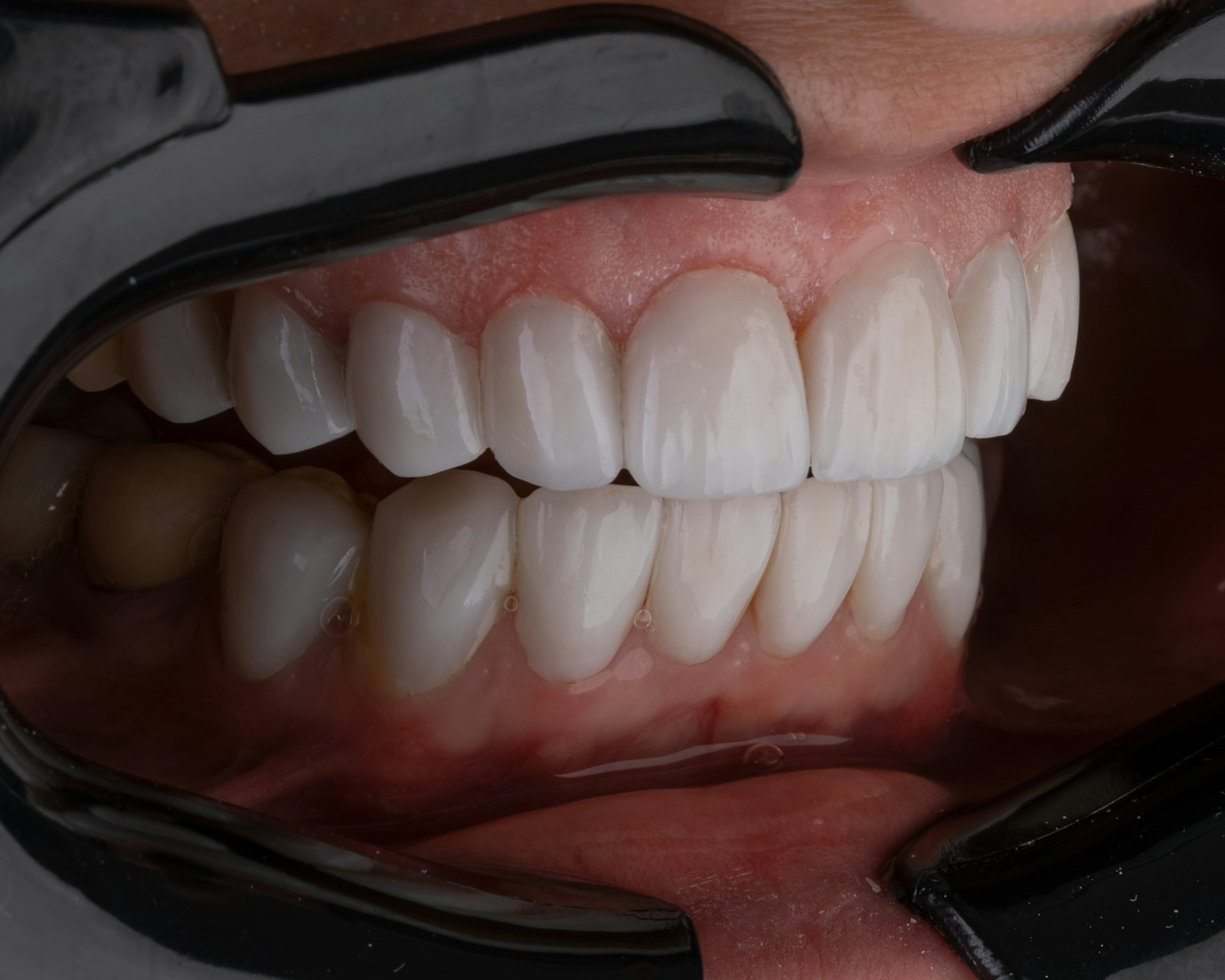 How Much Does It Cost to Rebond a Veneer? A Clear Guide