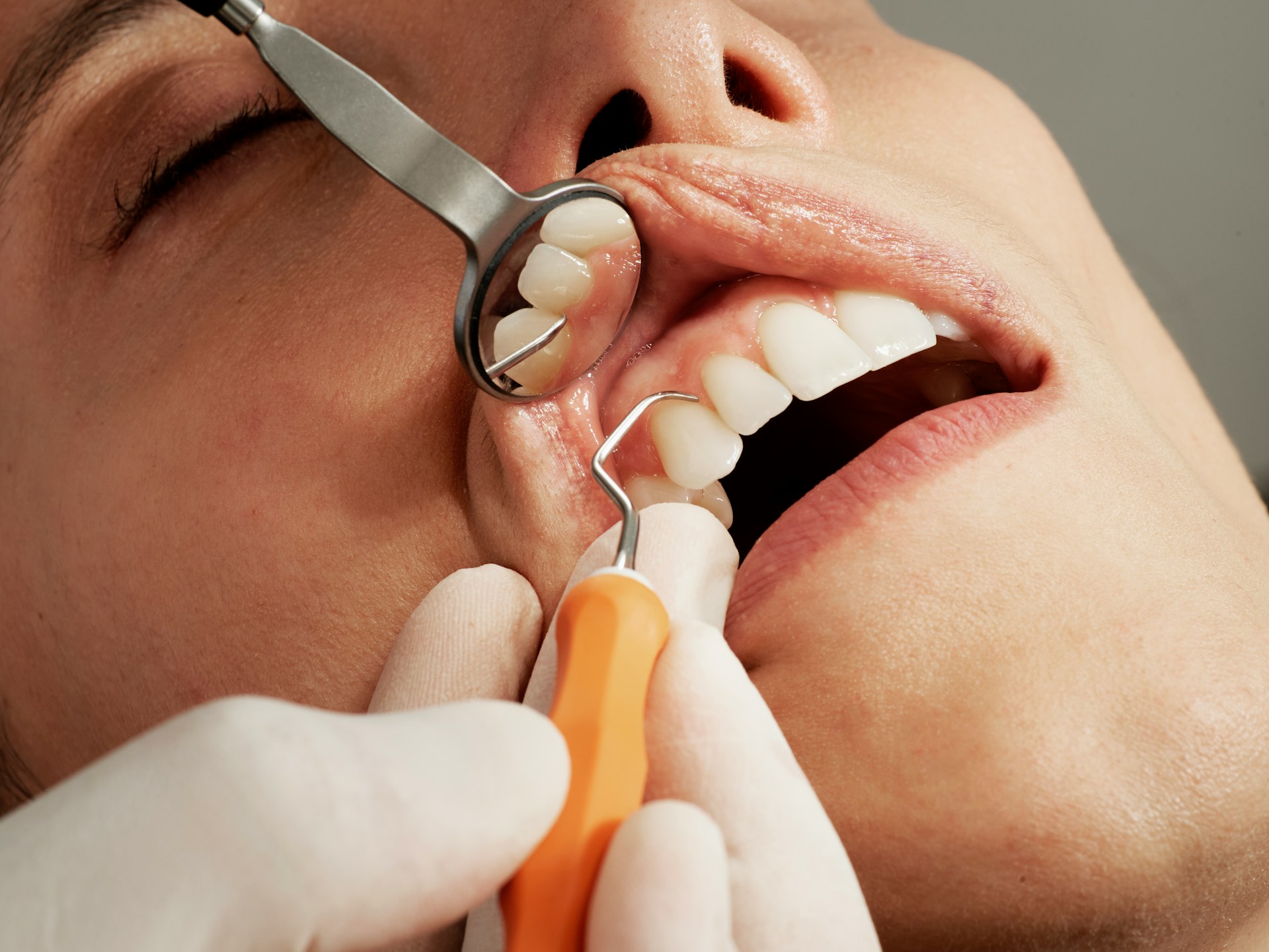 Veneers vs Bonding: Cost Comparison 2026