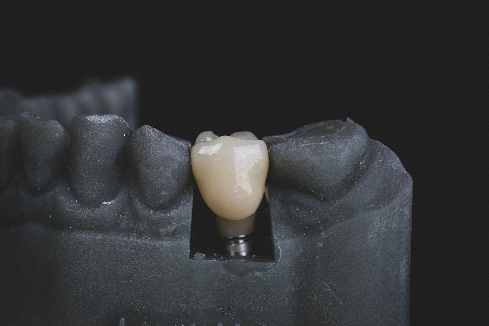 Why Dental Implant Prices Vary So Much in the UK (£1,500 vs £4,500)
