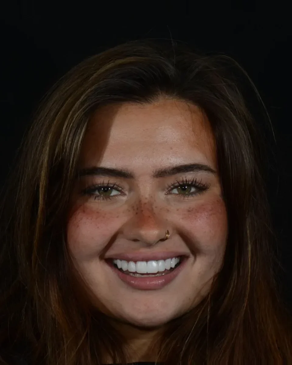 The same patient after her composite bonding, smiling