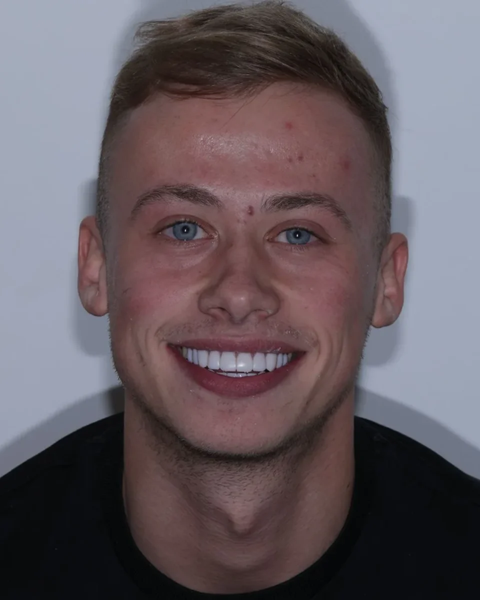 The same patient after his smile treatment, smiling