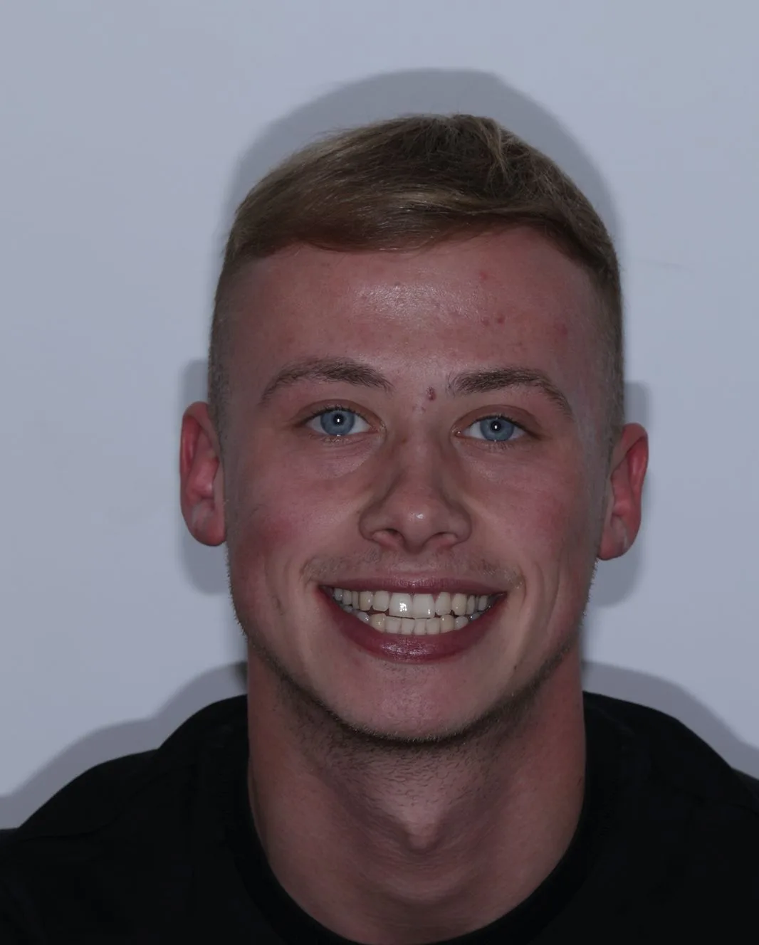 A patient before his smile treatment at UrgentCare Dental