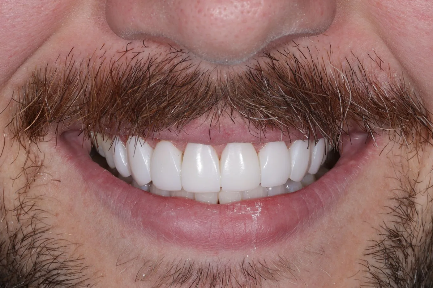 The same teeth after treatment, close up