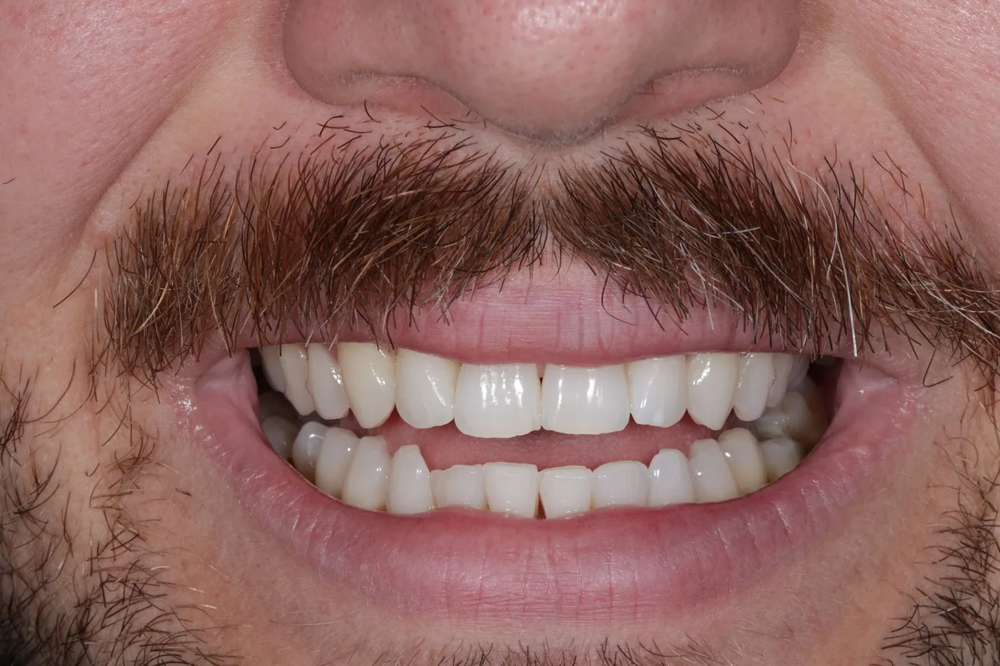 A close view of a patient's teeth before treatment