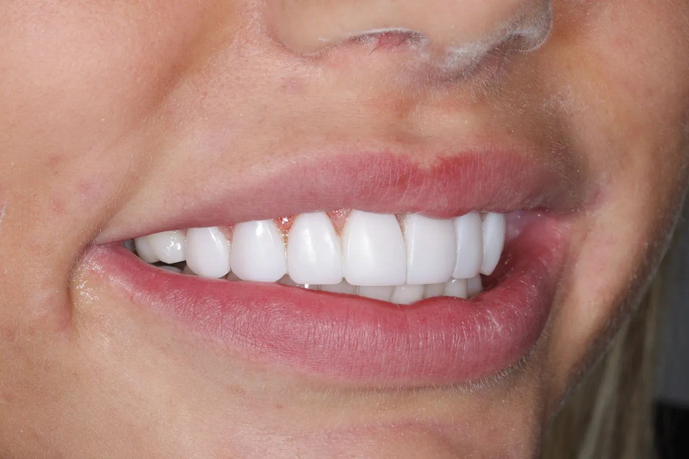 The same teeth after treatment, close up
