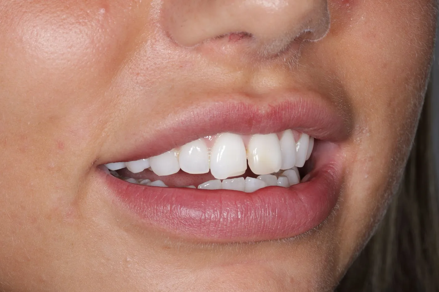 A close view of a patient's teeth before treatment