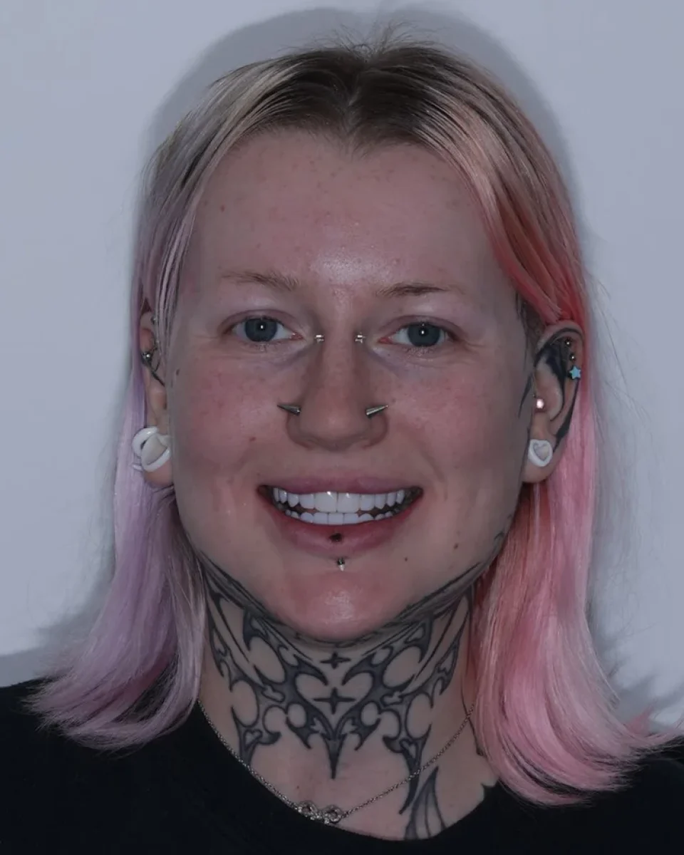 The same patient after her smile treatment, smiling